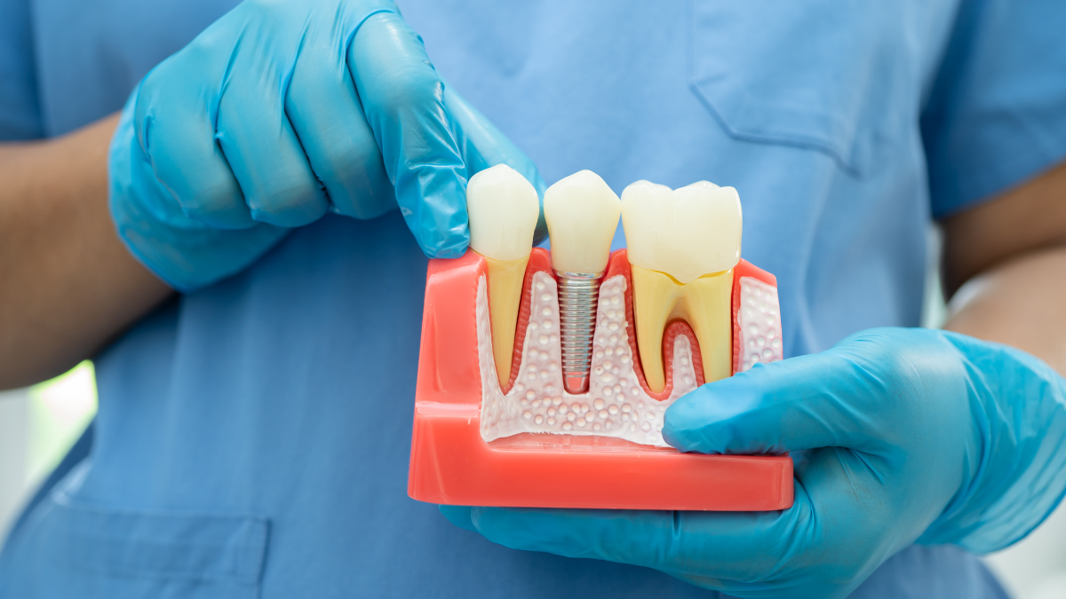 Impianti dentali: quando è il momento giusto per intervenire?