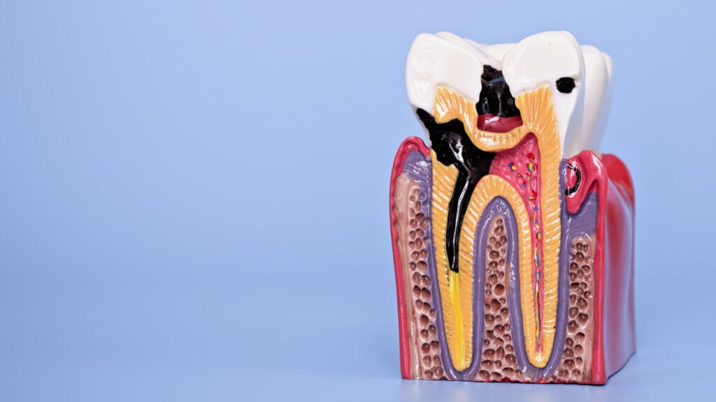 Parodontite: cause, sintomi e prevenzione